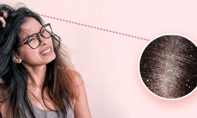 قشرة الرأس - أفضل 4 خطوات للعلاج